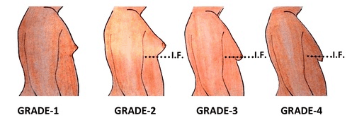 Risperdal Breast Growth Development in Boys The NHCAA